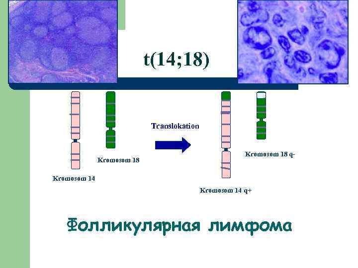 t(14; 18) Translokation Kromosom 18 q- Kromosom 14 q+ Фолликулярная лимфома 