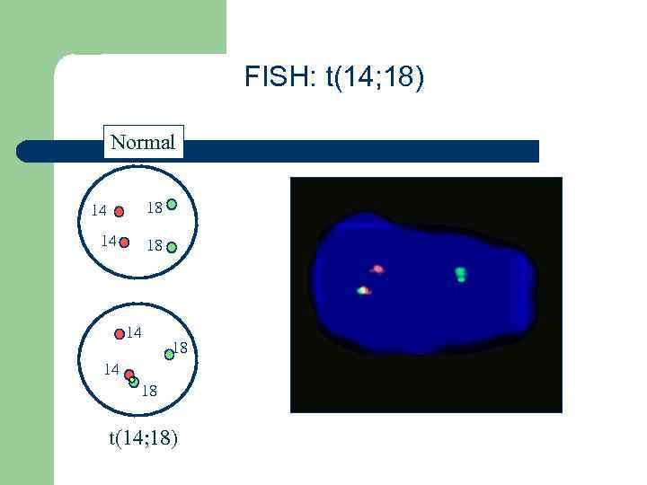 FISH: t(14; 18) Normal 18 14 14 18 t(14; 18) 