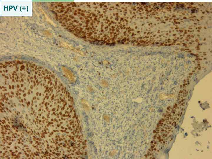 HPV (+) 