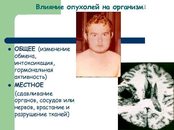 Влияние опухолей на организм: l l ОБЩЕЕ (изменение обмена, интоксикация, гормональная активность) МЕСТНОЕ (сдавливание