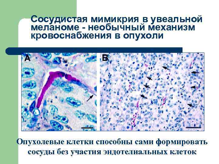 Сосудистая мимикрия в увеальной меланоме - необычный механизм кровоснабжения в опухоли Опухолевые клетки способны