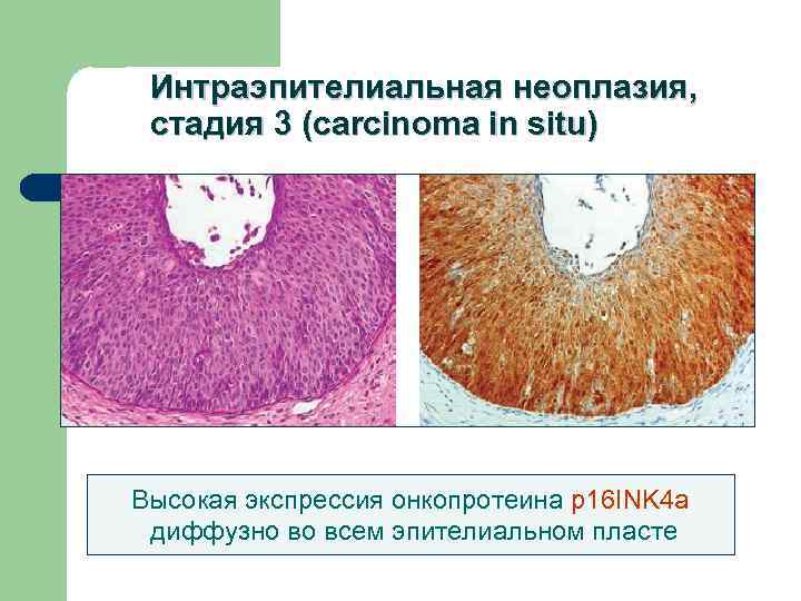 Простатическая интраэпителиальная неоплазия