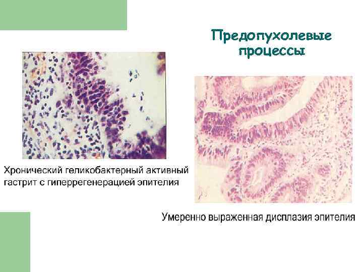 Предопухолевые процессы 