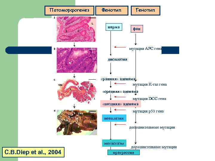 Патоморфогенез Фенотип норма Генотип фон мутация АРС гена дисплазия «ранняя» аденома мутация K-ras гена