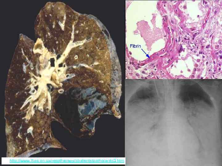Мурманск, 2005 По: http: //www. lhsc. on. ca/resptherapy/students/patho/ards 3. htm 45 