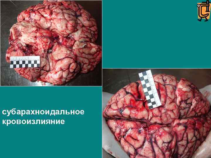 субарахноидальное кровоизлияние 