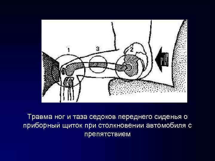Травма ног и таза седоков переднего сиденья о приборный щиток при столкновении автомобиля Травма ног и таза седоков переднего сиденья о приборный щиток при столкновении автомобиля