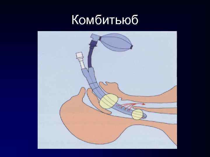 Критерии эффективности дыхания • Сатурация 92 – 94% • Розовые ногти и губы Критерии эффективности дыхания • Сатурация 92 – 94% • Розовые ногти и губы