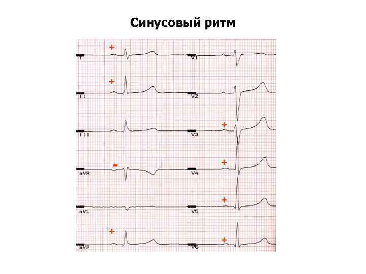 Синусовый ритм + + + - + + 