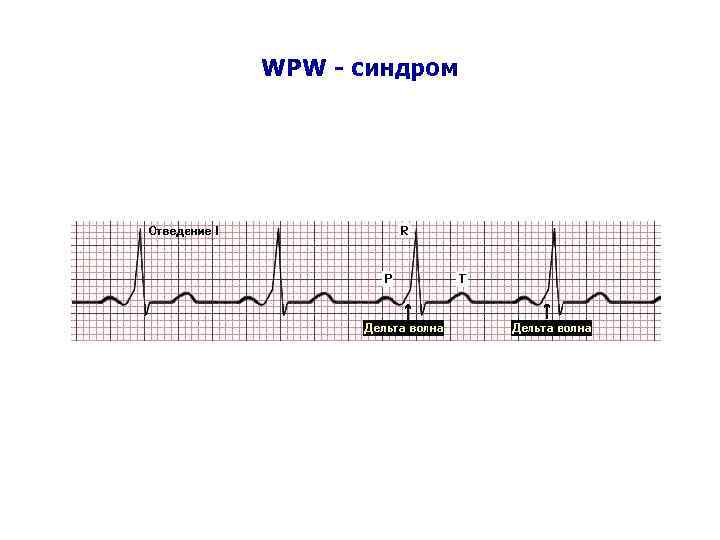 WPW - синдром 