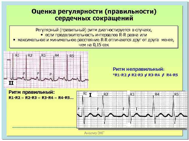 Оценка регулярности (правильности) сердечных сокращений Регулярный (правильный) ритм диагностируется в случаях, • если продолжительность