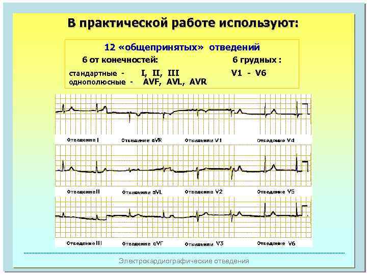 В практической работе используют: 12 «общепринятых» отведений 6 от конечностей: стандартные однополюсные - I,