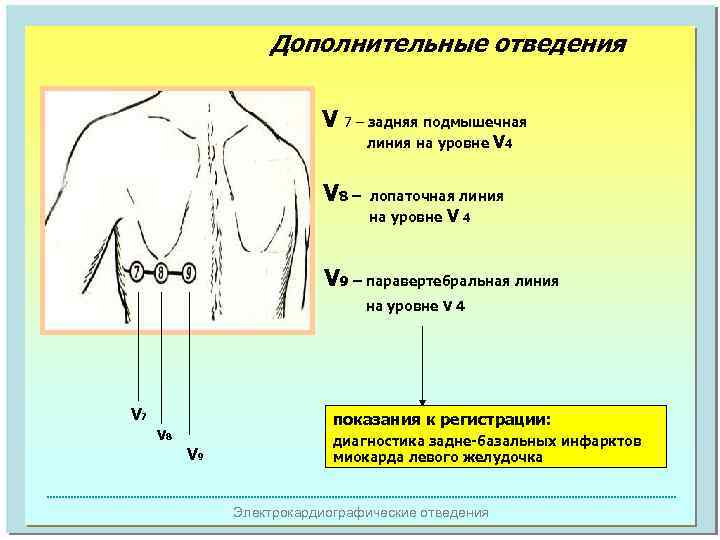 Дополнительные отведения V 7 – задняя подмышечная линия на уровне V 8 – V