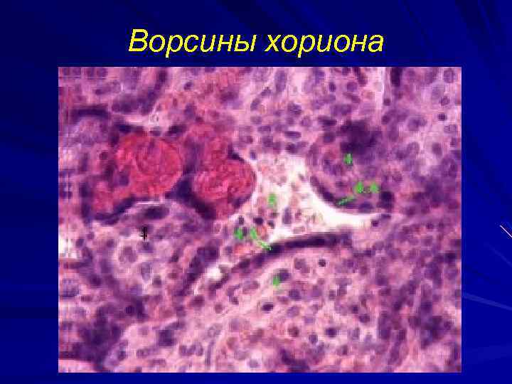 Ворсины хориона 