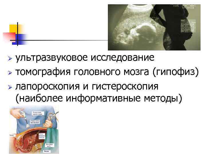ультразвуковое исследование Ø томография головного мозга (гипофиз) Ø лапороскопия и гистероскопия (наиболее информативные методы)