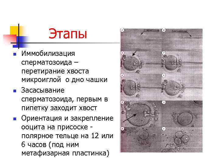 Этапы n n n Иммобилизация сперматозоида – перетирание хвоста микроиглой о дно чашки Засасывание
