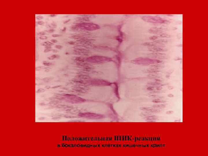 Положительная ШИК-реакция в бокаловидных клетках кишечных крипт. 