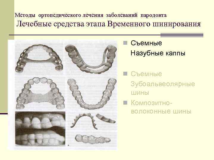 Методы ортопедического лечения заболеваний пародонта Лечебные средства этапа Временного шинирования n Съемные Назубные каппы