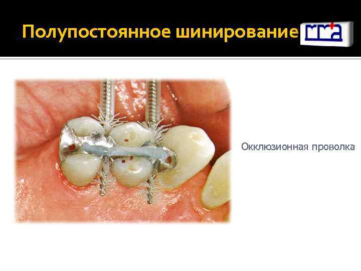 Полупостоянное шинирование Окклюзионная проволка 