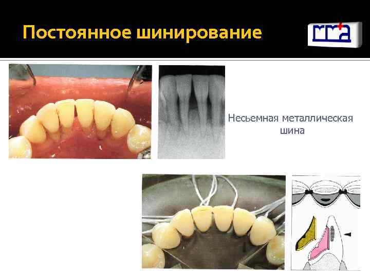 Шинирование зубов при ортопедическом лечении заболеваний пародонта презентация