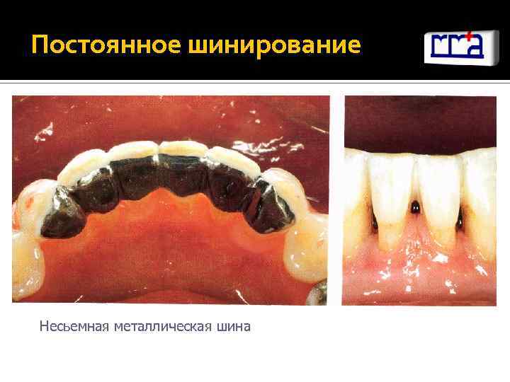 Постоянное шинирование Несьемная металлическая шина 