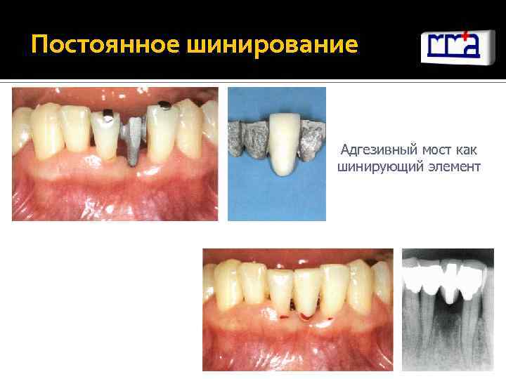 Постоянное шинирование Адгезивный мост как шинирующий элемент 
