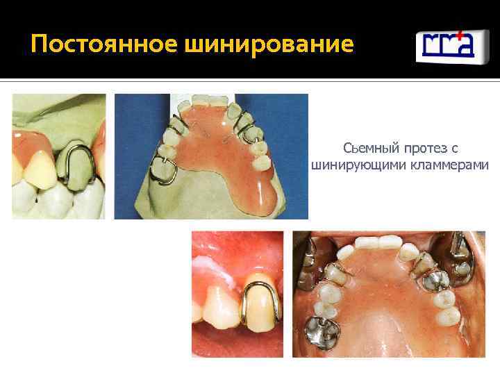 Постоянное шинирование Сьемный протез с шинирующими кламмерами 