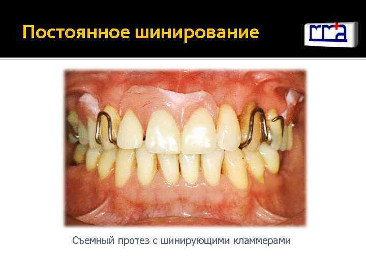 Постоянное шинирование Съемный протез с шинирующими кламмерами 