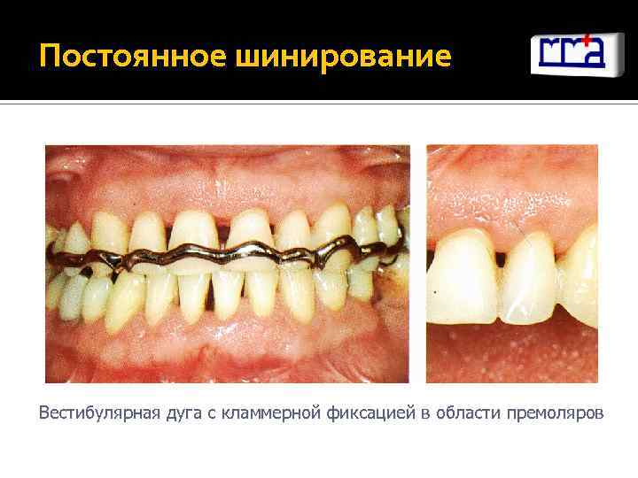 Постоянное шинирование Вестибулярная дуга с кламмерной фиксацией в области премоляров 