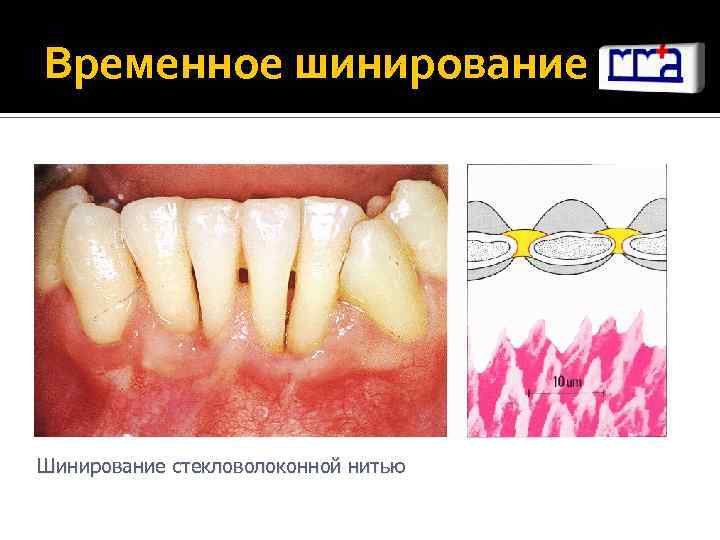 Временное шинирование Шинирование стекловолоконной нитью 