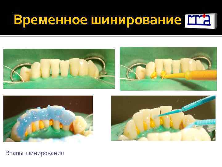 Постоянное шинирование при заболеваниях пародонта презентация