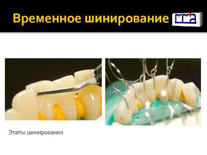 Виды шинирования в ортопедической стоматологии презентация