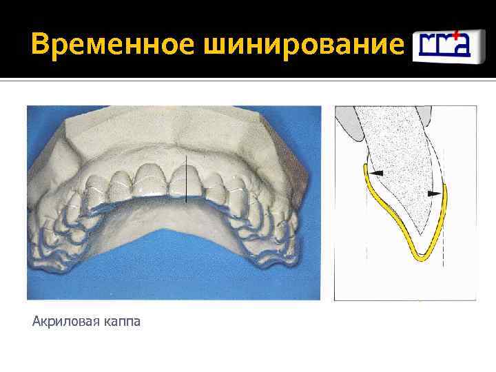 Временное шинирование Акриловая каппа 
