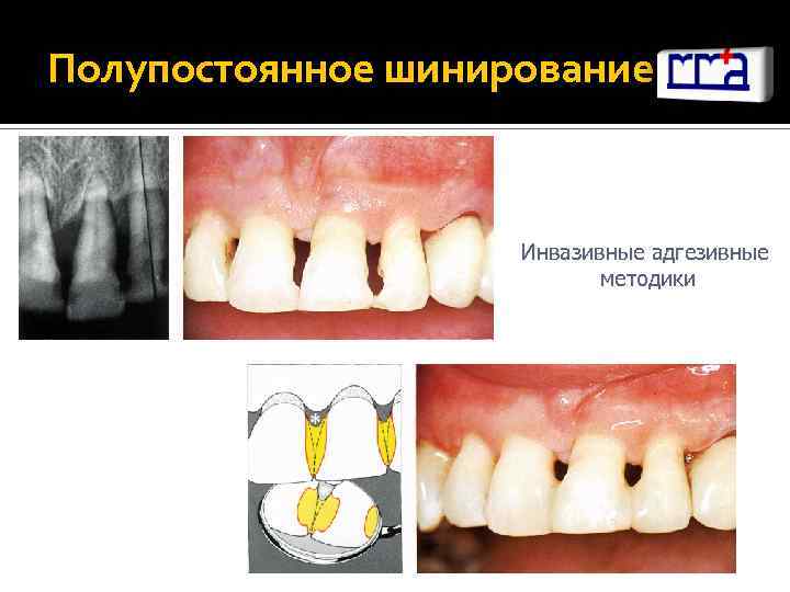 Полупостоянное шинирование Инвазивные адгезивные методики 