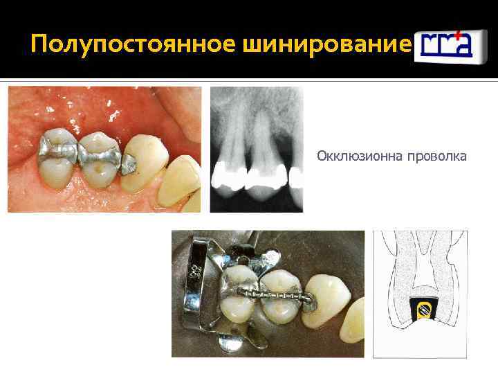 Полупостоянное шинирование Окклюзионна проволка 