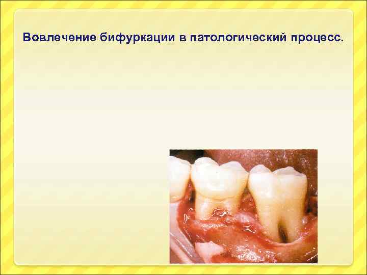 Вовлечение бифуркации в патологический процесс. 