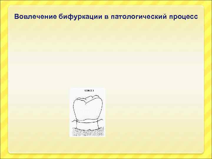 Вовлечение бифуркации в патологический процесс 