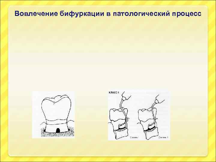 Вовлечение бифуркации в патологический процесс 