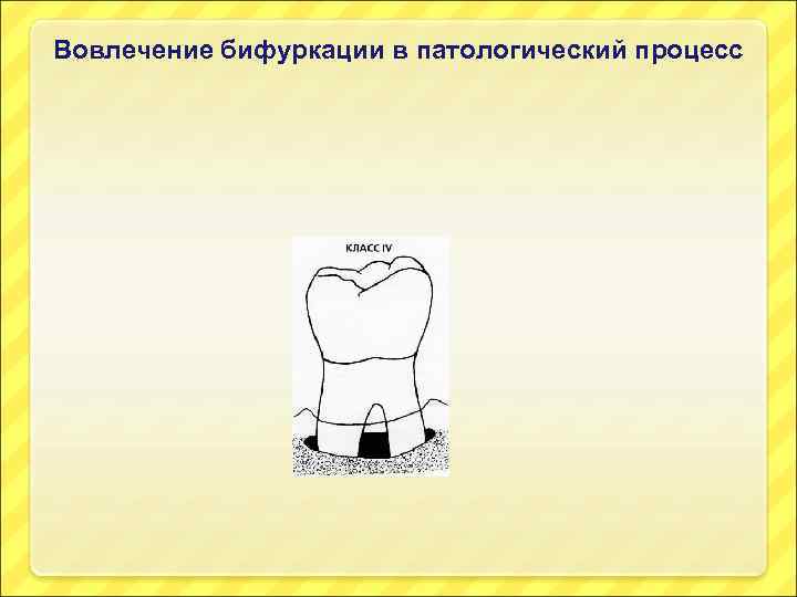 Вовлечение бифуркации в патологический процесс 