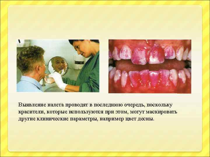 Выявление налета проводят в последнюю очередь, поскольку красители, которые используются при этом, могут маскировать