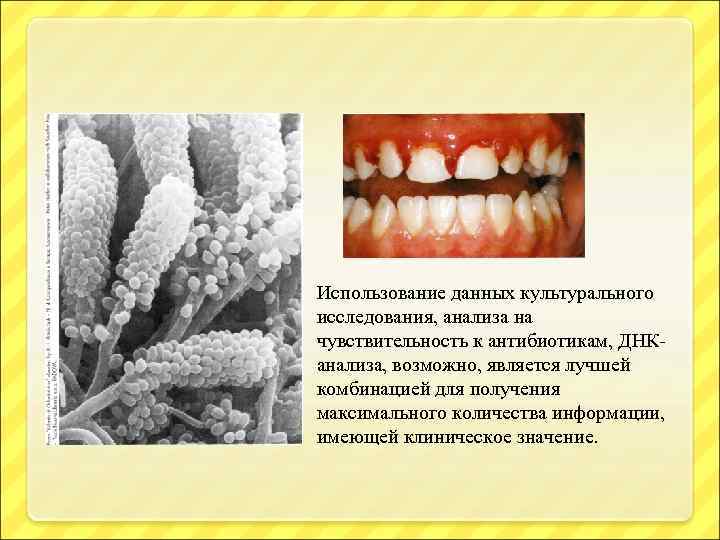 Использование данных культурального исследования, анализа на чувствительность к антибиотикам, ДНКанализа, возможно, является лучшей комбинацией