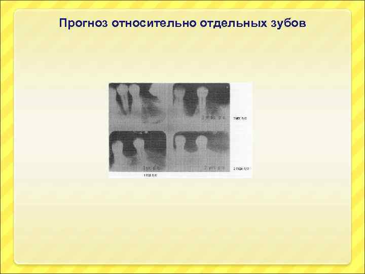 Прогноз относительно отдельных зубов 