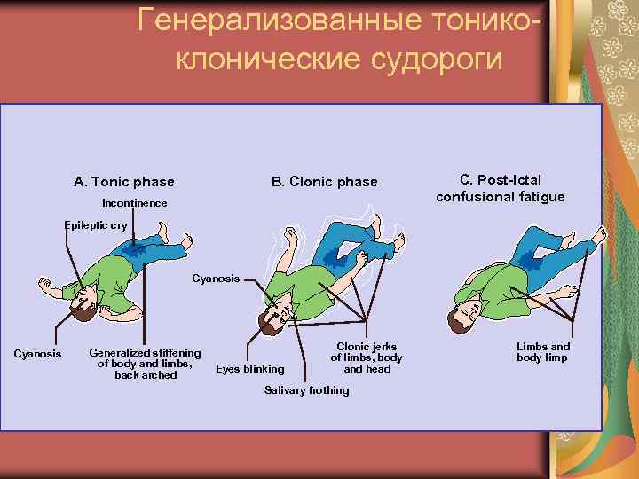 Генерализованные тоникоклонические судороги A. Tonic phase B. Clonic phase Incontinence C. Post-ictal confusional fatigue