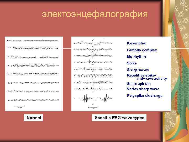электоэнцефалография K-complex Lambda complex Mu rhythm Spike Sharp waves Repetitive spikeand-wave activity Sleep spindle
