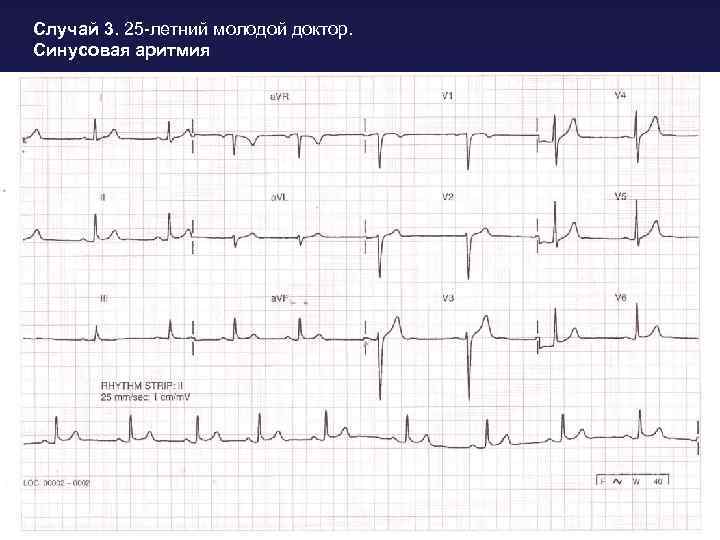 Случай 3. 25 -летний молодой доктор. Синусовая аритмия 