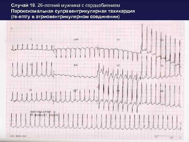 Случай 18. 26 -летний мужчина с сердцебиением Пароксизмальная суправентрикулярная тахикардия (re-entry в атриовентрикулярном соединении)