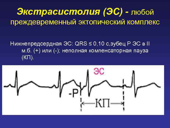 Экстрасистолия (ЭС) - любой преждевременный эктопический комплекс Нижнепредсердная ЭС: QRS ≤ 0, 10 с,