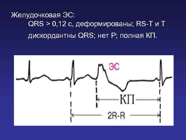 Желудочковая ЭС: QRS > 0, 12 c, деформированы; RS-T и Т дискордантны QRS; нет
