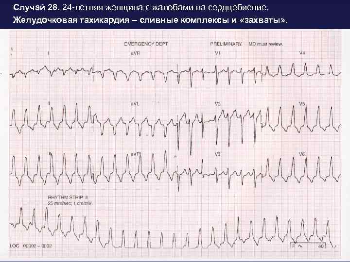 Случай 28. 24 -летняя женщина с жалобами на сердцебиение. Желудочковая тахикардия – сливные комплексы