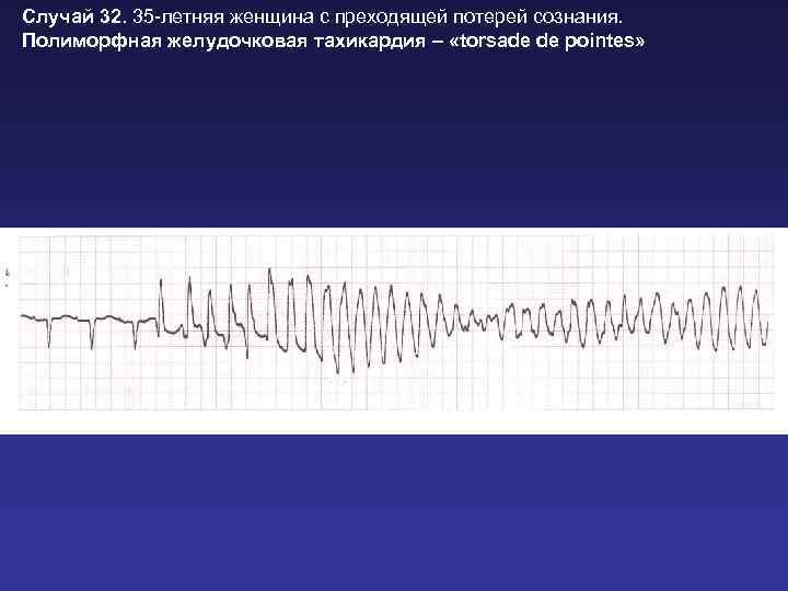 Случай 32. 35 -летняя женщина с преходящей потерей сознания. Полиморфная желудочковая тахикардия – «torsade